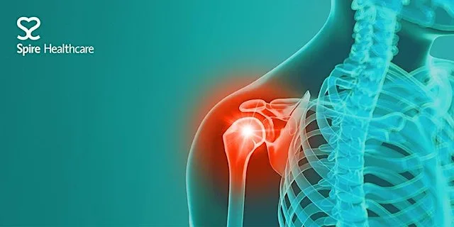 Common shoulder conditions explained – free patient event (Spire Bristol) at Spire Bristol Hospital
