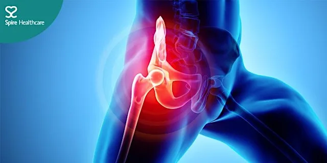 Free patient event: hip replacement information evening at Spire Cardiff Hospital