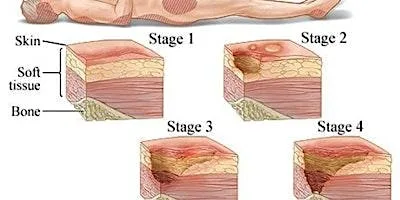 PGH Tissue viabilty session at Poole Hospital - Education Centre