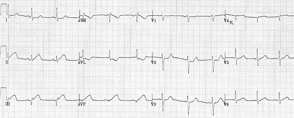 ECG workshop for STEMI, STEMI equivalents and STEMI mimic patterns.