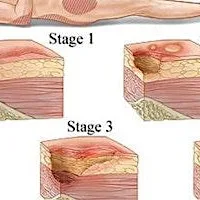 PGH -Overview of Tissue Viability