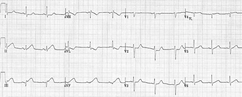 ECG workshop for STEMI, STEMI equivalents and STEMI mimic patterns.