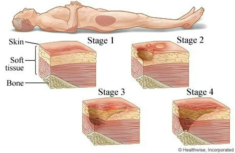 PGH Tissue Viability session